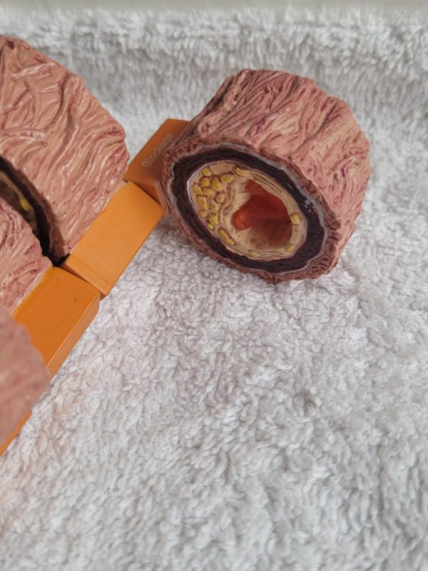 Plastiek arterie en ziekte - Afbeelding 4