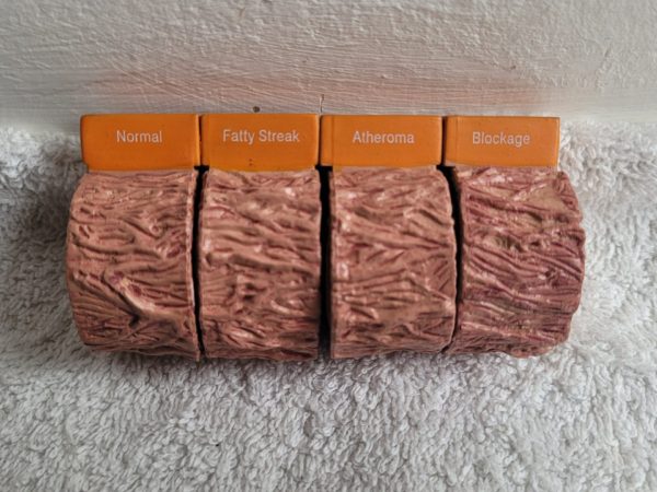 Plastiek arterie en ziekte - Afbeelding 2