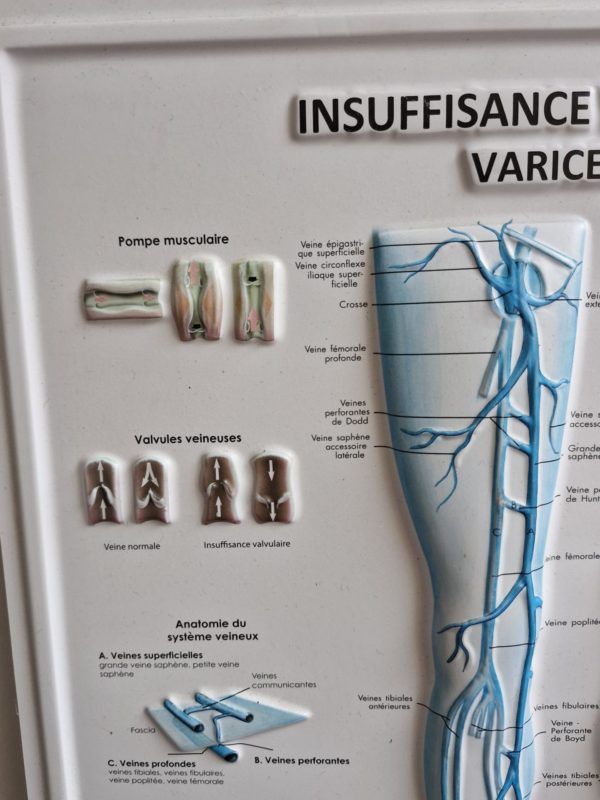 Medische plaat Varices ( spataderen) - Afbeelding 5