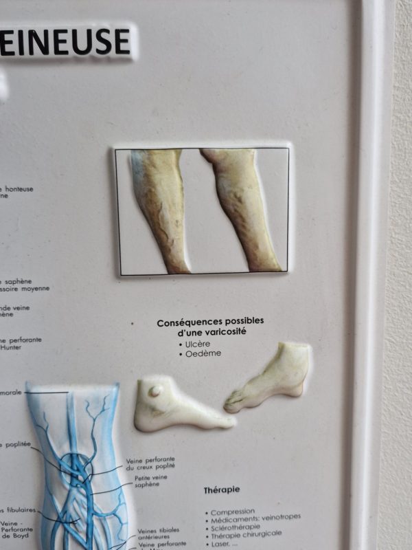 Medische plaat Varices ( spataderen) - Afbeelding 2
